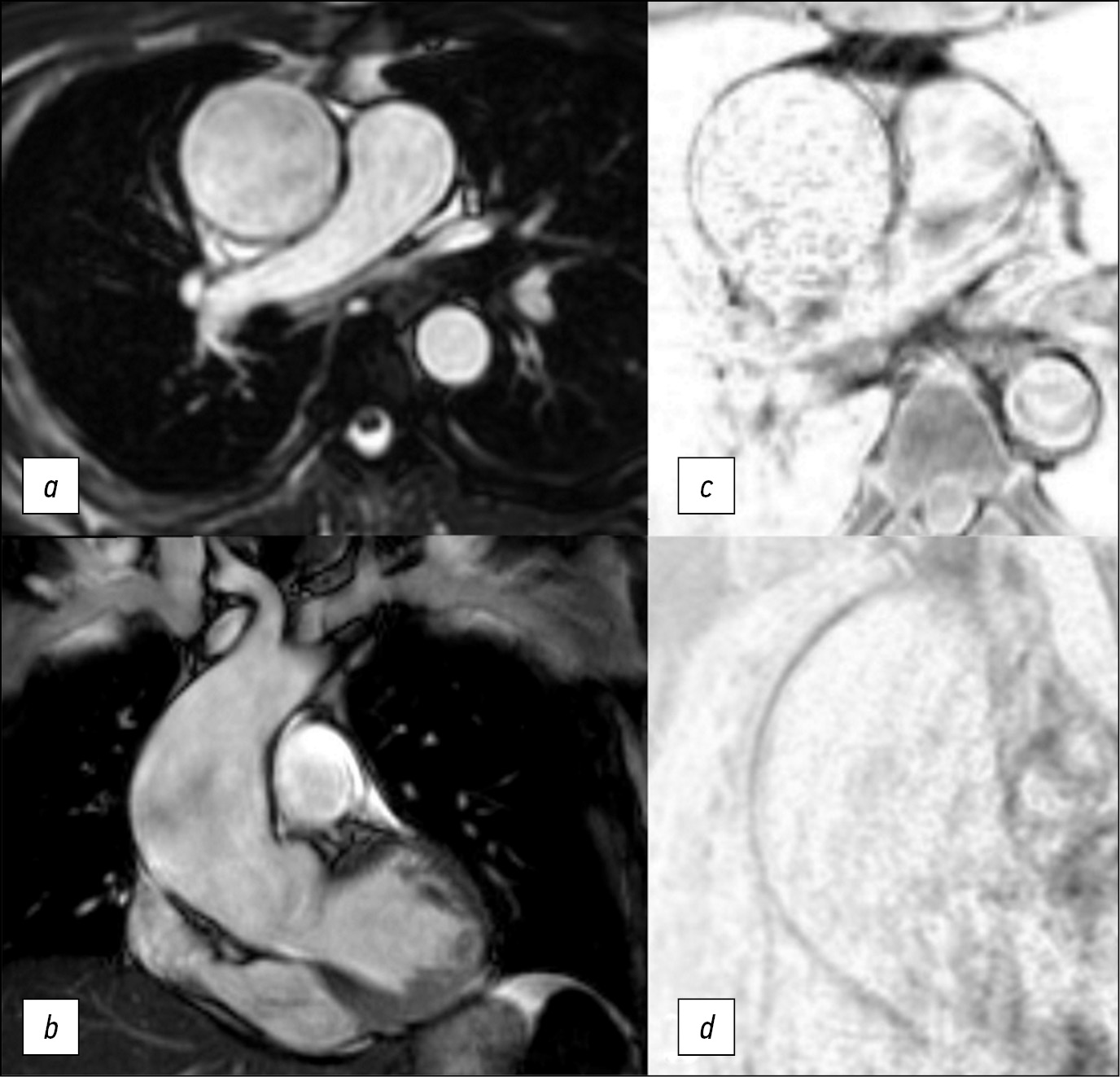 Diagnostic challenge: innovative approach in use of magnetic resonance imaging in aortic aneurysm